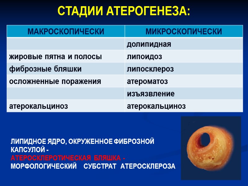 СТАДИИ АТЕРОГЕНЕЗА:  ЛИПИДНОЕ ЯДРО, ОКРУЖЕННОЕ ФИБРОЗНОЙ КАПСУЛОЙ -   АТЕРОСКЛЕРОТИЧЕСКАЯ  БЛЯШКА